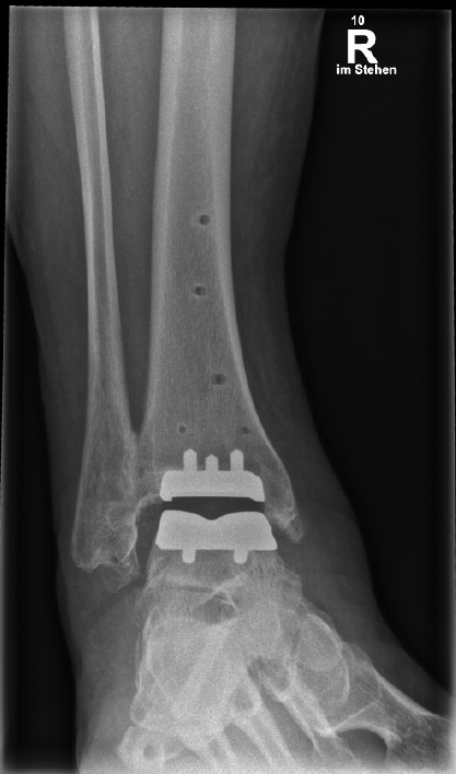 Röntgenaufnahme des rechten Sprunggelenks mit eingesetzter Prothese im Stand zur postoperativen Kontrolle.